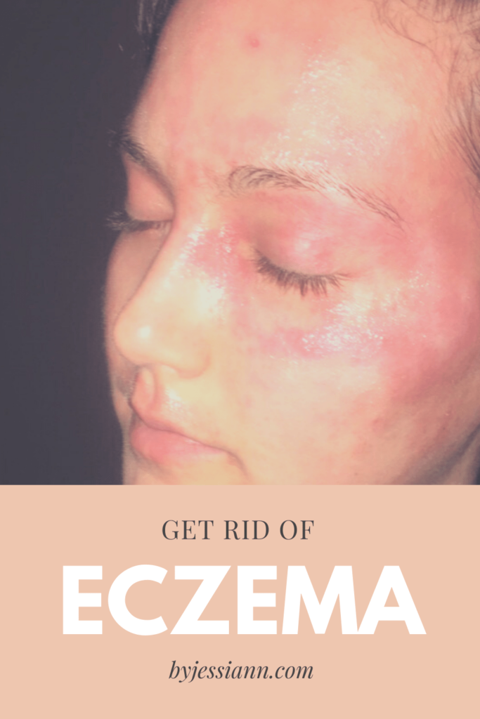 how to cure eczema